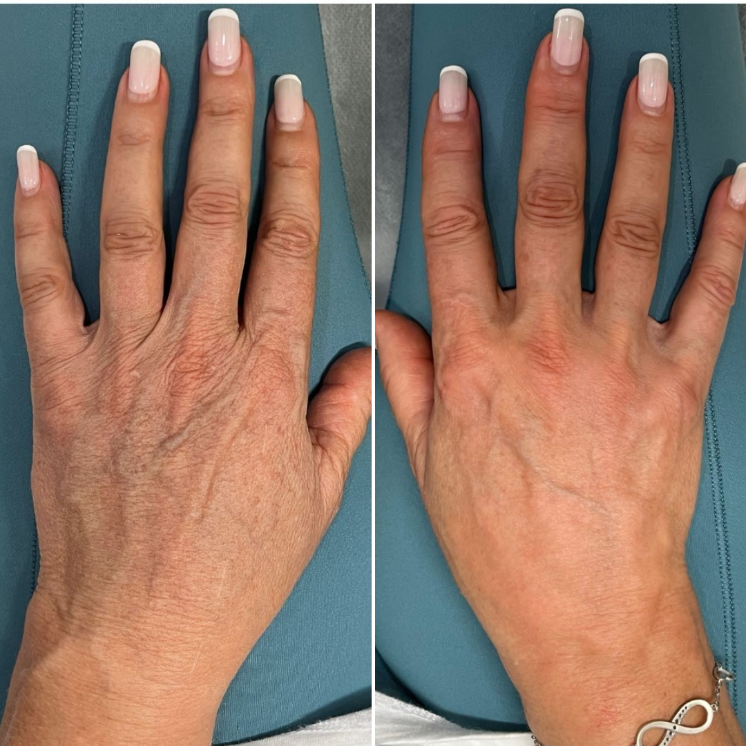 🏆 LIMITED-TIME 30% OFF! ✨Skavix™ YouthLift Retinol Hand Cream